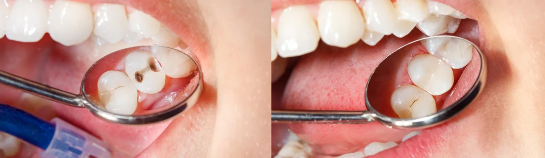 A mouth with fillings in a tooth.